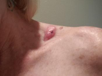 breast cancer met to skin in my left clavicle area after the biopsy