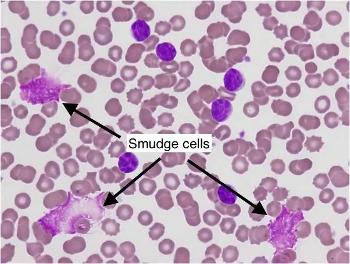 Smudge cells are due to the weaker CLL cell walls breaking