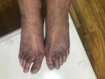 ? Diabetic feet