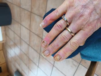 Raynauds nail problems 