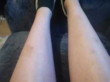 Bruise on legs. 