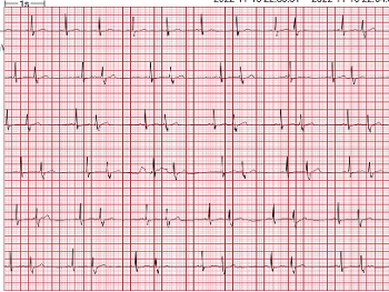 1 minute ECG showing 33 PAC's