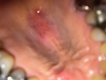 Lupus flare, palate of mouth