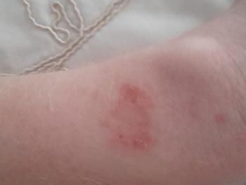 Skin irritation from smart watch
