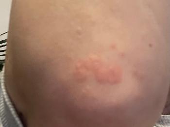 I took a photo of the blisters/rash , they are starting to go away now, 