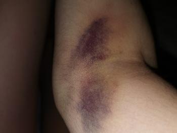 Picture of a bruise. 
