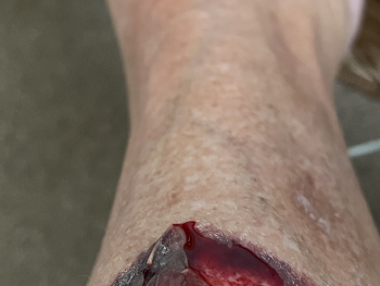 Leg wound