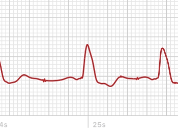 Apple Watch ECG showing premature ectopic beats with P waves and compensatory pauses.