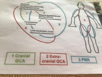 Diagram showing cross over of symptoms for GCA and PMR sufferers.