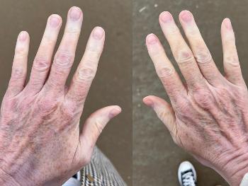 Colour photo showing secondary Raynaud’s 