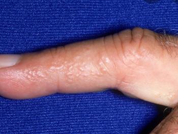 Finger with little blisters on the side. 
