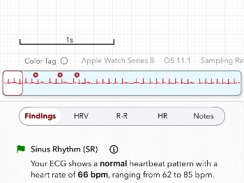 ECG analysis