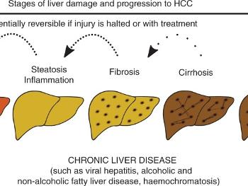 Stages of reversible liver disease. 