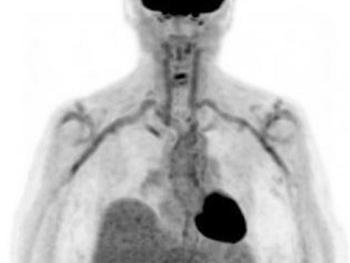 An FDG PET/CT scan of a patient with severe GCA and inflamed neck and shoulder arteries. 