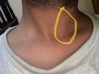 Small bulge on neck