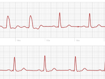 Apple Watch ECG showing ectopic beats and return to NSR