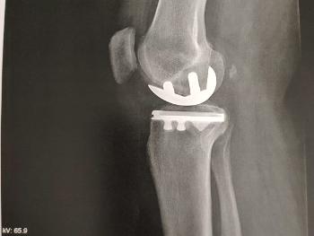 Partial knee replacement 