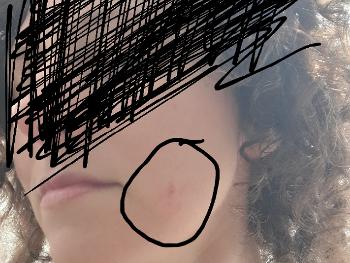 Image of blister/rash on face.
