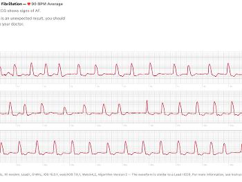 Apple Watch ECG Trace with AF