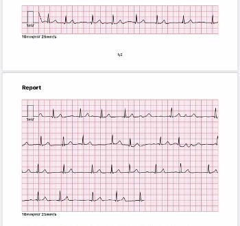 ECG 