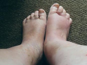 Ankle ulcers improving, of their own accord.