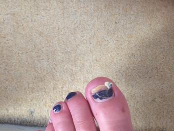 Ripped left big toenail because I am numb from the knees down. 