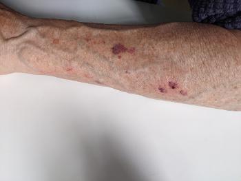 Photo of lower arm with bruising and skin tears.