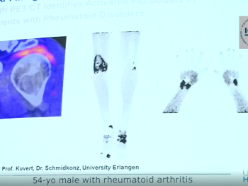 FAPI PET/CT image showing arthritis