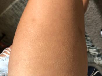 unusual patches of goosebumps along right thigh