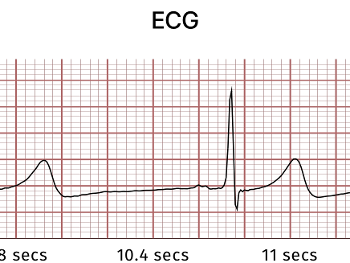 Qrs