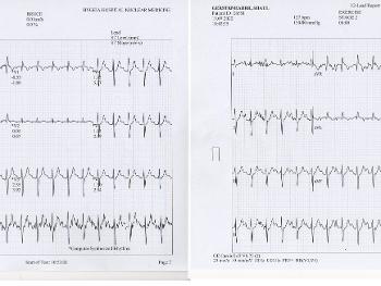 ECG at 6:00 min exertion and 0:50 min rest.
