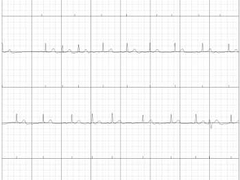 ECG trace