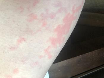 Inner thigh with strangely articulated red/purple blotchy/swirly rash.