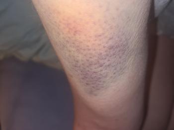 An example of my latest bruise