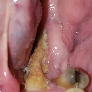 Osteonecrosis lower jaw due to Denosumab/Xgeva