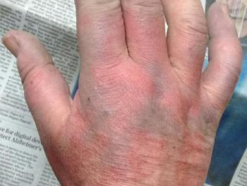 hand displaying Raynauds , purple in colour with red patches and white fingertips. 