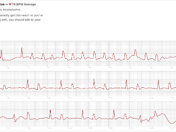 Apple ECG showing brief AF and ectopic beats