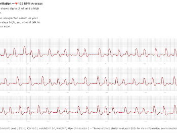 ECG showing LBBB and AF