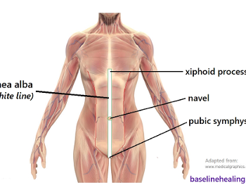 The linea alba, connecting the midline markers: pubic symphysis navel and xiphoid process
