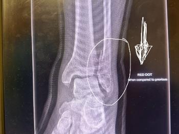 Weber b fracture displaced after slipped crutches and landed on plaster cast