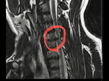 MRI of neck Spinal Cord and vertebrae 