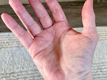 Colour photo of Erythromelalgia in my palm