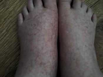 Swollen and discoloured feet.