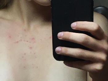 Possible rash