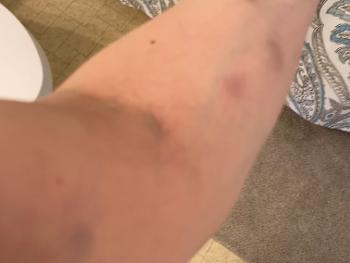 Arm bruises 