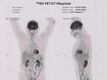 The patient's status is negative! Black is the place of physiological accumulation of FDG.
