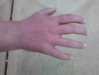 Hand and wrist swelling