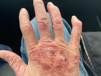 Hand dermatitis as a side effect of Mycophenolate??