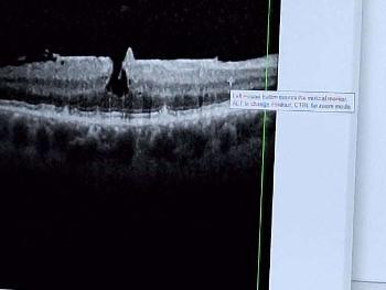 Macular Hole