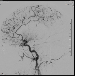 angiogram lest side showing blockage at start of MCA with moyamoya like vessels. plaque?